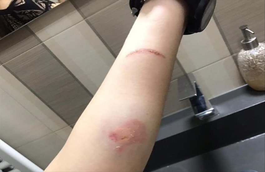 Infermiera aggredita a morsi a Frattamaggiore: ennesimo episodio sconcertante in corsia