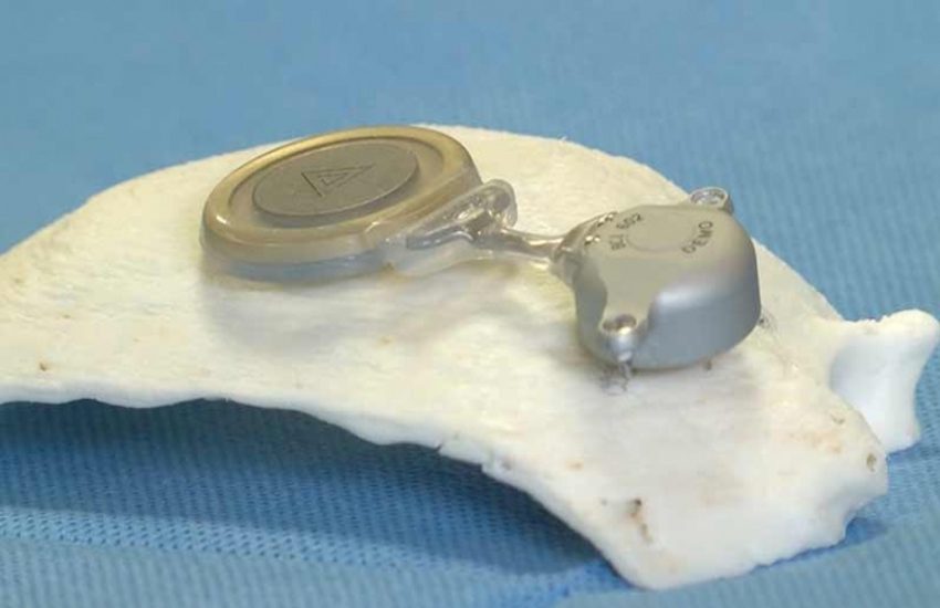 Santobono, eccezionale intervento con ricostruzione in 3D: bimba recupera l’udito