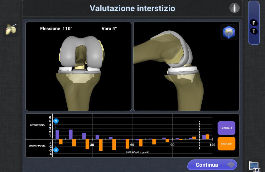CTO Torino, robot impianta protesi anatomica al ginocchio: è la prima volta in Italia