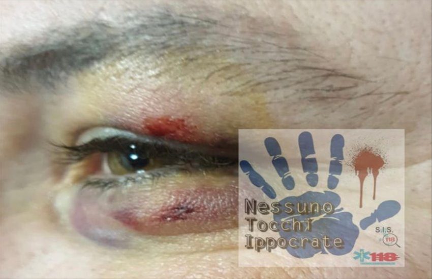 Giugliano in Campania, pugni sul volto dell’autista di un’ambulanza accusato di eccessivo ritardo