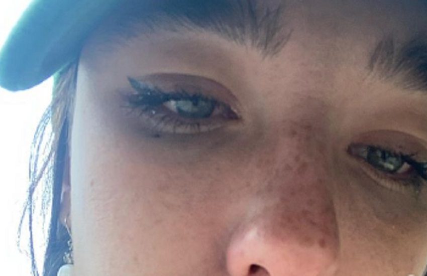 Matilda De Angelis, l’acne e l’ansia: lo sfogo social in occasione dell’Acne awareness month