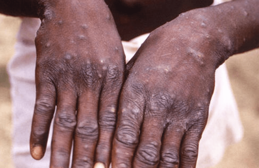 Ora il vaiolo delle scimmie preoccupa: arrivano i primi decessi in Europa e in Italia aumentano i casi