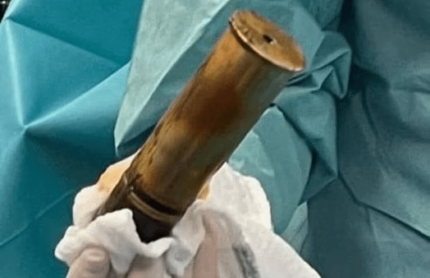 “Dottore, ho una bomba nel sedere”: ospedale evacuato e intervento chirurgico