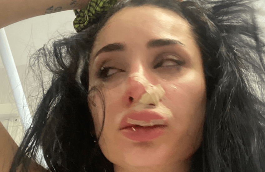 Greta Menchi aggredita al volto da un cane: “Mi hanno ricucito per un’ora” (VIDEO)