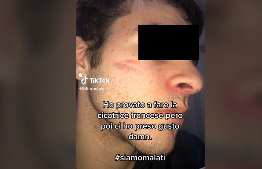 Cicatrice francese, il nuovo folle trend che spopola su TikTok preoccupa i genitori