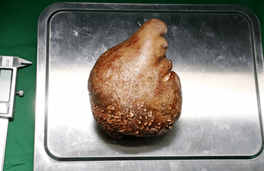 Asportato il calcolo renale più grande del mondo: “Era grosso quanto un pompelmo”
