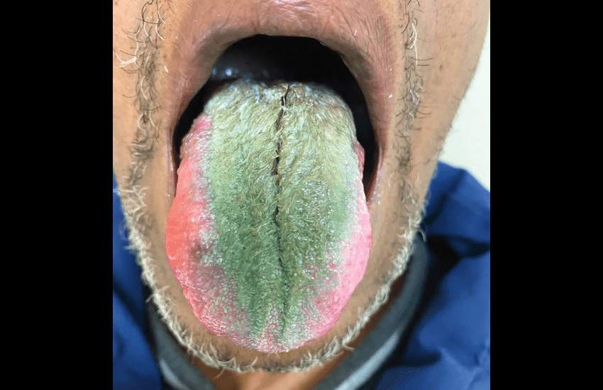 Lingua verde e pelosa: il caso di un paziente affetto dalla singolare sindrome