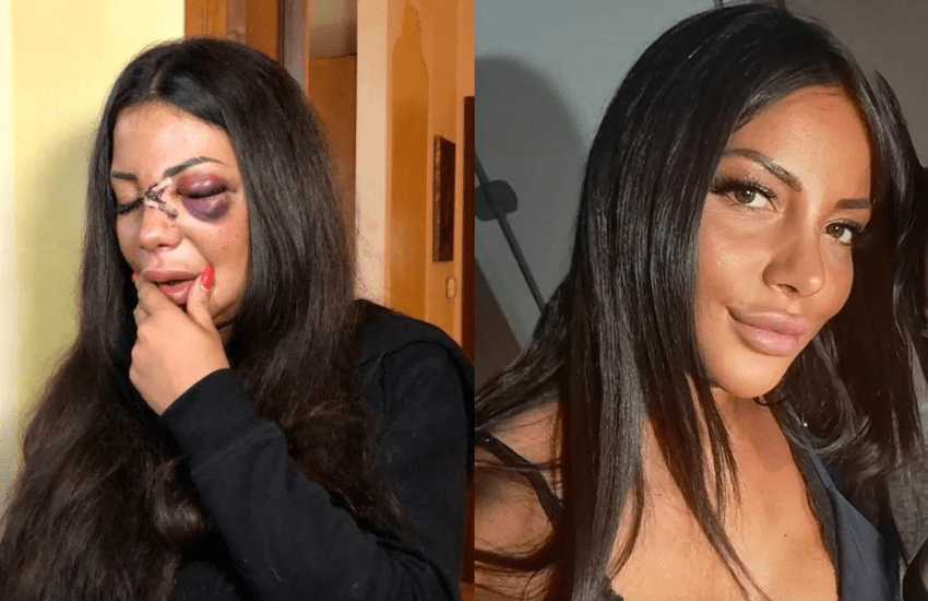 Prato, picchiata e sfregiata: “Non sono l’unica vittima del mio ex”