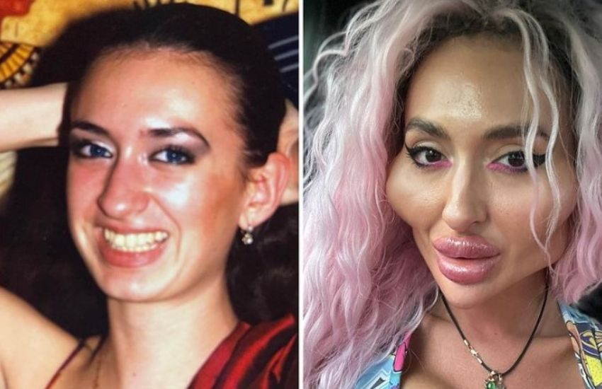 Conquista il record di donna con le guance più grandi del mondo: “Eri bellissima, ora sei un mostro!”
