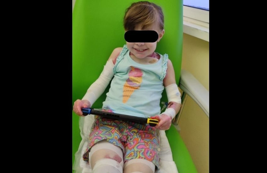 L’incredibile storia di Rebecca, la bambina farfalla: la sua pelle si distrugge con un semplice tocco