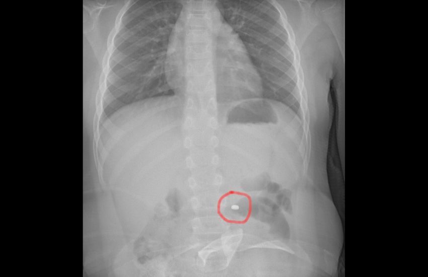 Catania, bimbo ingoia pila “a bottone”, salvato in sala operatoria