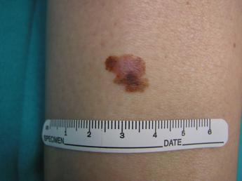 Cancro, oncologo: “Tre anni per vaccino mRna contro melanoma”